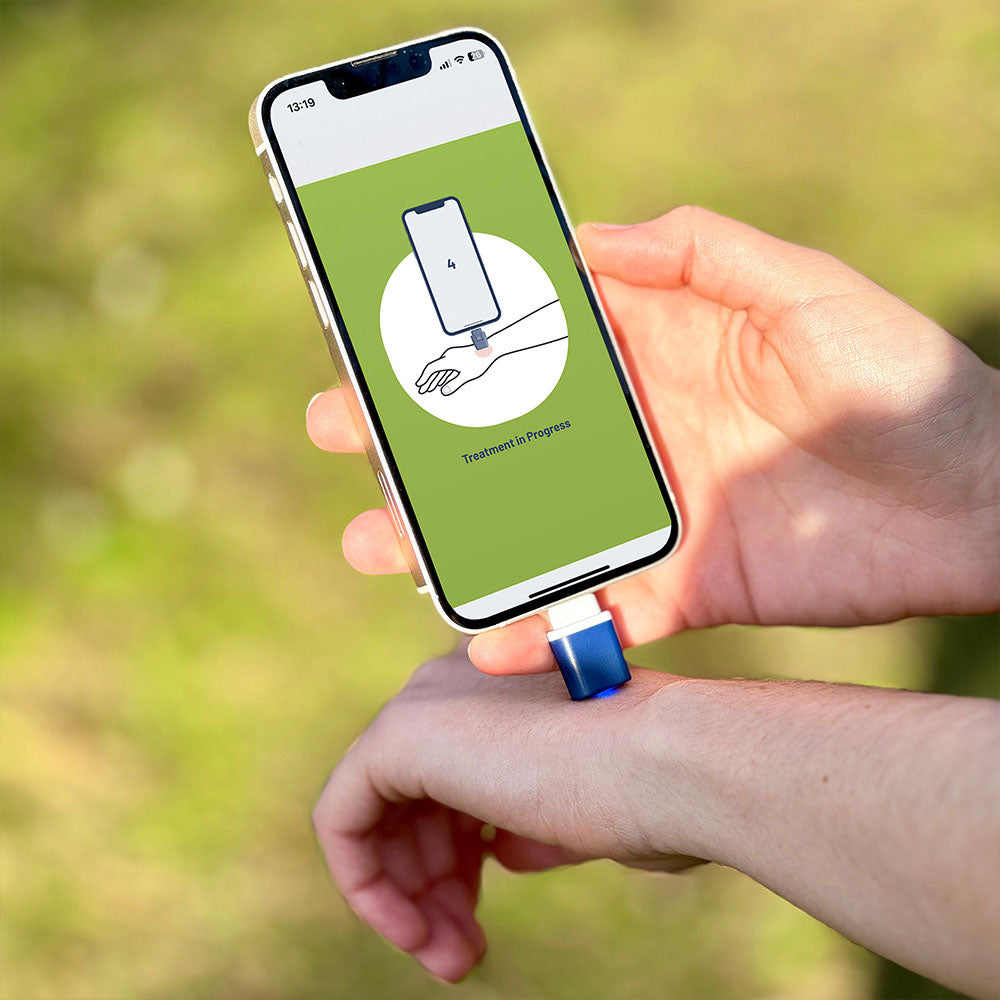 모기 물린 후 냉찜질과 온찜질의 가려움 효과 비교